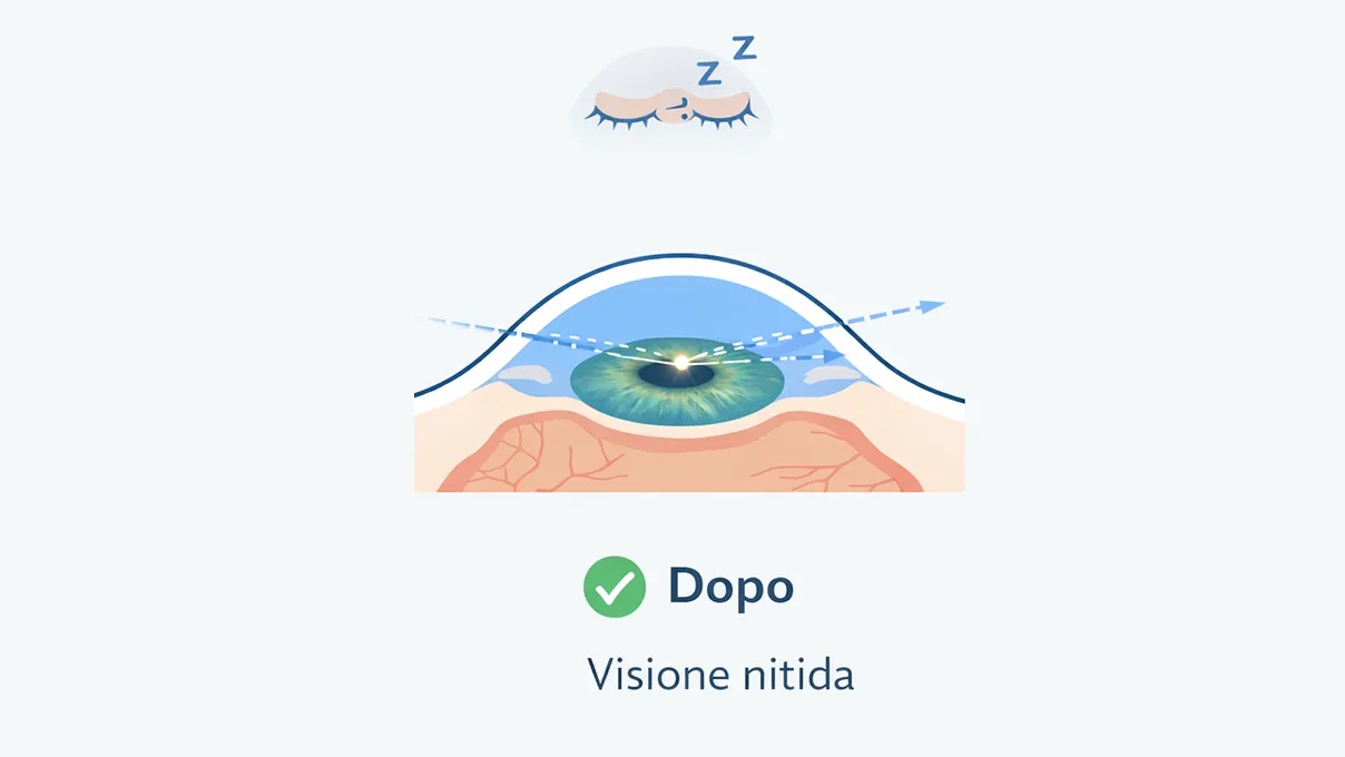 Illustrazione visione dopo aver usato lente ortocheratologica