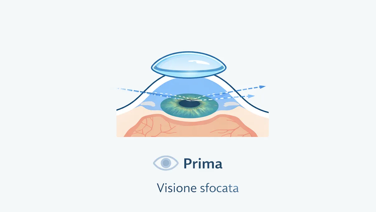 Illustrazione visione prima di usare lente ortocheratologica